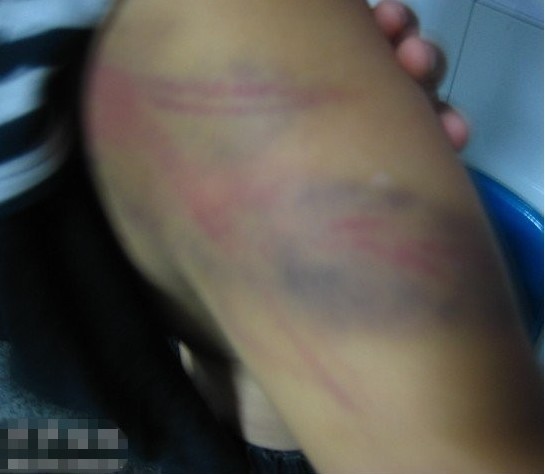 被打肿腿部存在大片淤青