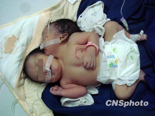 广东茂名出生一名双头女婴 仅有一个心脏